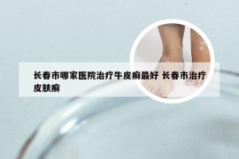 长春市哪家医院治疗牛皮癣最好 长春市治疗皮肤癣