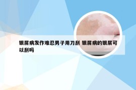 银屑病发作难忍男子用刀刮 银屑病的银屑可以刮吗