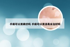 手癣可以用碘伏吗 手癣可以用消毒水治好吗