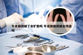 牛皮癣挠破了会扩散吗 牛皮肤癣抓破会传染吗