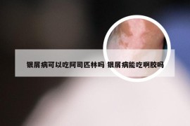 银屑病可以吃阿司匹林吗 银屑病能吃啊胶吗