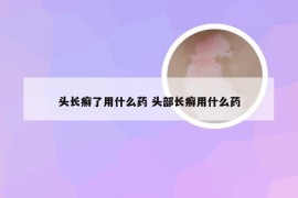 头长癣了用什么药 头部长癣用什么药