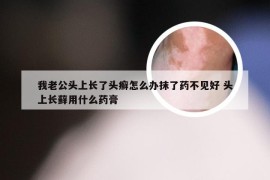 我老公头上长了头癣怎么办抹了药不见好 头上长藓用什么药膏