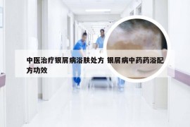 中医治疗银屑病浴肤处方 银屑病中药药浴配方功效