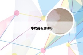 牛皮癣会发硬吗