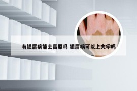 有银屑病能去高原吗 银屑病可以上大学吗