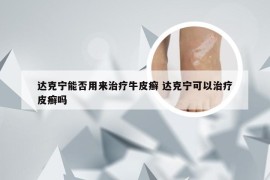 达克宁能否用来治疗牛皮癣 达克宁可以治疗皮癣吗