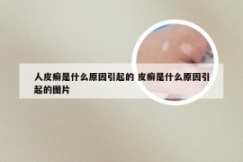 人皮癣是什么原因引起的 皮癣是什么原因引起的图片