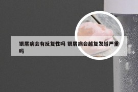 银屑病会有反复性吗 银屑病会越复发越严重吗