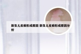 新生儿皮癣形成原因 新生儿皮癣形成原因分析