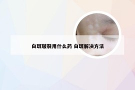 白斑皲裂用什么药 白斑解决方法