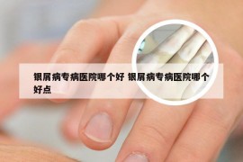 银屑病专病医院哪个好 银屑病专病医院哪个好点