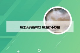 癣怎么药最有效 癣治疗小妙招