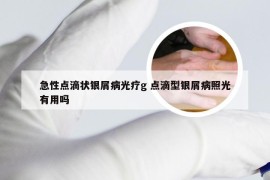 急性点滴状银屑病光疗g 点滴型银屑病照光有用吗