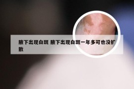 腋下出现白斑 腋下出现白斑一年多可也没扩散