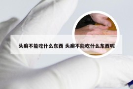 头癣不能吃什么东西 头癣不能吃什么东西呢