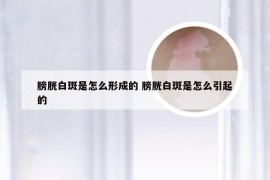 膀胱白斑是怎么形成的 膀胱白斑是怎么引起的