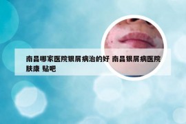 南昌哪家医院银屑病治的好 南昌银屑病医院肤康 贴吧