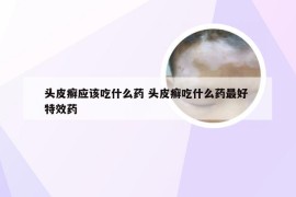 头皮癣应该吃什么药 头皮癣吃什么药最好 特效药