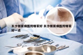 长沙银屑病医院哪家好 长沙银屑病医院哪家好一点