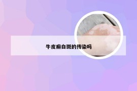 牛皮癣白斑的传染吗