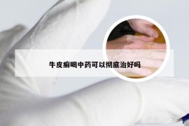 牛皮癣喝中药可以彻底治好吗