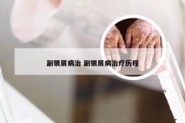 副银屑病治 副银屑病治疗历程