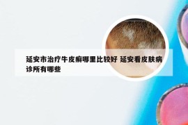 延安市治疗牛皮癣哪里比较好 延安看皮肤病诊所有哪些