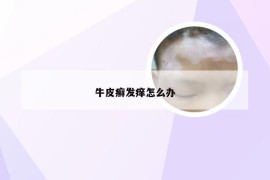 牛皮癣发痒怎么办