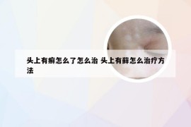 头上有癣怎么了怎么治 头上有藓怎么治疗方法