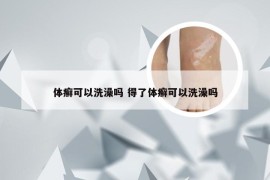 体癣可以洗澡吗 得了体癣可以洗澡吗