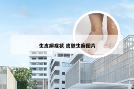 生皮癣症状 皮肤生癣图片