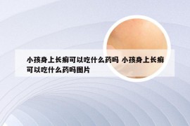 小孩身上长癣可以吃什么药吗 小孩身上长癣可以吃什么药吗图片