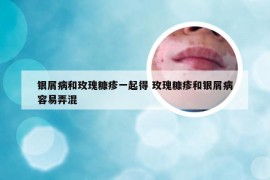 银屑病和玫瑰糠疹一起得 玫瑰糠疹和银屑病容易弄混