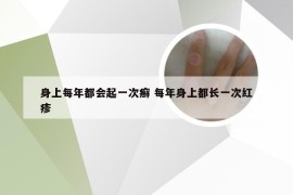 身上每年都会起一次癣 每年身上都长一次红疹