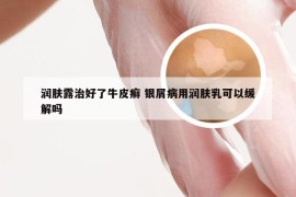 润肤露治好了牛皮癣 银屑病用润肤乳可以缓解吗