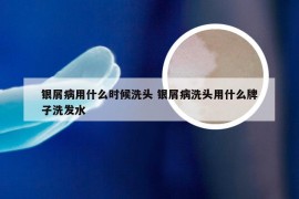 银屑病用什么时候洗头 银屑病洗头用什么牌子洗发水