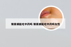 银屑病能吃中药吗 银屑病能吃中药吗女性