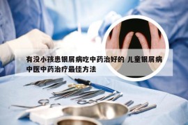 有没小孩患银屑病吃中药治好的 儿童银屑病中医中药治疗最佳方法