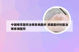 中国哪家医院治银屑病最好 我国最好的医治银屑病医院