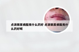 点滴银屑病服用什么药好 点滴银屑病服用什么药好呢