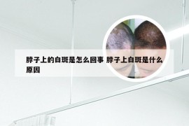 脖子上的白斑是怎么回事 脖子上白斑是什么原因