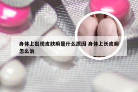 身体上出现皮肤癣是什么原因 身体上长皮癣怎么治