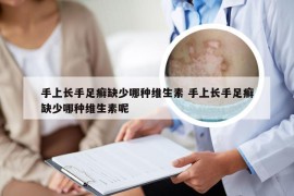 手上长手足癣缺少哪种维生素 手上长手足癣缺少哪种维生素呢