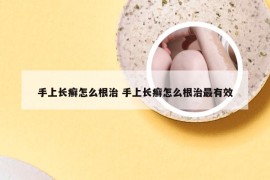 手上长癣怎么根治 手上长癣怎么根治最有效