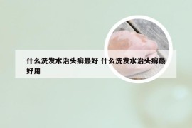 什么洗发水治头癣最好 什么洗发水治头癣最好用