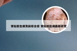 掌趾脓包病发前综合症 掌趾脓包病最新研究