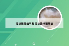 深圳银屑病不发 深圳治疗银屑病