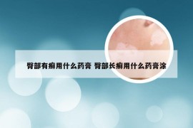 臀部有癣用什么药膏 臀部长癣用什么药膏涂