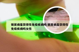 银屑病是获得性免疫疾病吗 银屑病是获得性免疫疾病吗女性